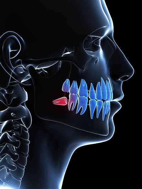 20 Closeup X Ray Of Impacted Wisdom Tooth Stock Photos Pictures