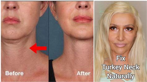 Best Face Yoga Exercises And Massage To Tighten Saggy Neck Tone Turkey