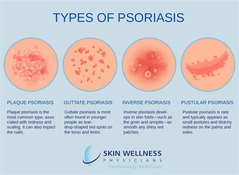 Psoriasis Naples Fl Skin Wellness Physicians