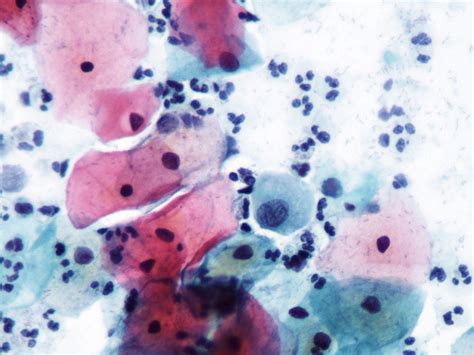 Atipia De Significado Indeterminado