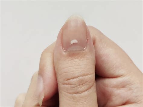 Top 198 What Are The Causes Of White Spots On Nails Architectures
