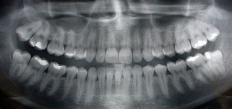 How To Take X Rays Of Teeth Teethwalls