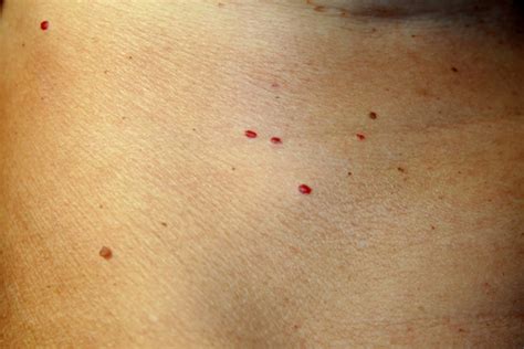 Find the perfect cherry angioma stock photo. What is a Cherry Angioma?