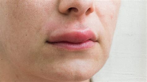 Swollen Lip Causes And Treatments My Best Dentists Journal