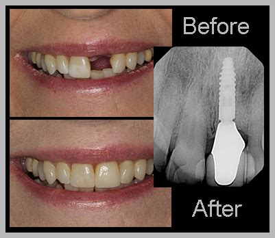 The implant procedure is designed to after the implant is placed, a healing period is needed before a final crown can be fitted on top. My Gallery
