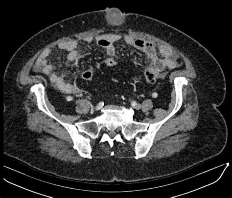 Abdominal Computed Tomography Scan Solid Mass At The Umbilical Region