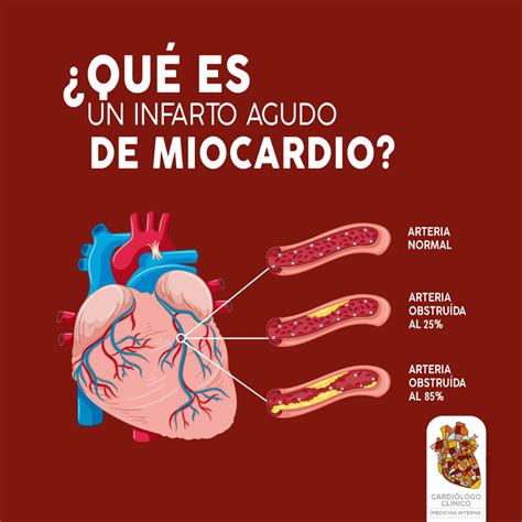 🫀🩺⚠ El Infarto Agudo De Miocardio Es Una Necrosis Miocárdica Que Se