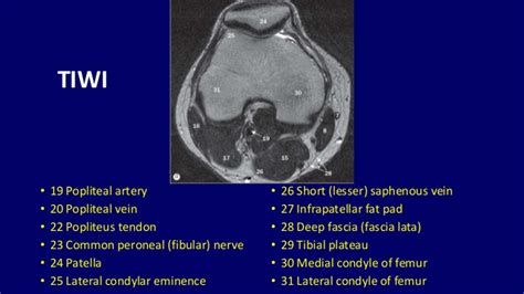 Mr imaging of knees having isolated and combined ligament injuries. Mri anatomy of knee Dr. Muhammad Bin Zulfiqar