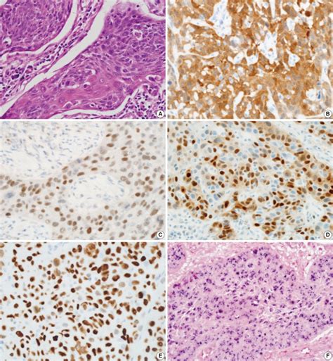 Representative Photographs Of Tonsillar Squamous Cell Carcinoma Stained Download Scientific