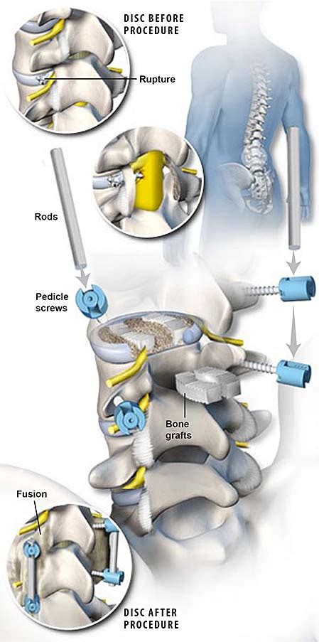 Plif Posterior Lumbar Interbody Fusion Central Coast Orthopedic