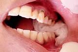 Most simple extractions should heal within 7 to 10 days. Dental Care: After a Tooth Extraction: How to Take a ...