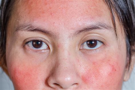 Facial Rash Causes And Tips