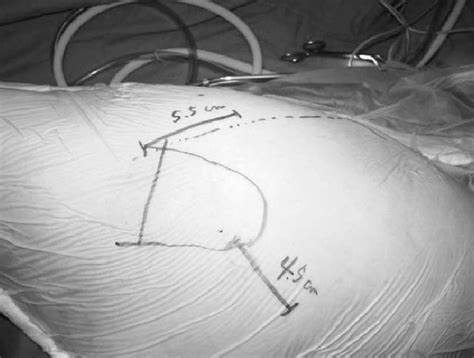 The Skin Incision Line Of Modified Two Incision Mis Tha Download