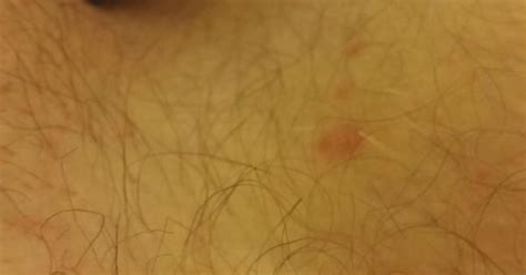Discovered This Rash On The Inside Of My Thigh As Well As Balantis On