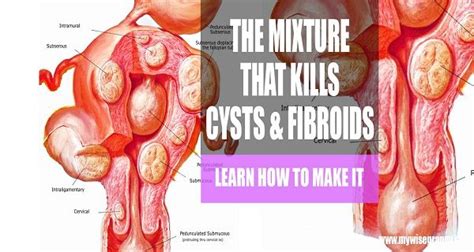 I've had multiple cysts on my right breast that grow and shrink depending on my hormonal cycle for several years now. Fibroid Removal Laparoscopic | Fibroid diet, Fibroid ...