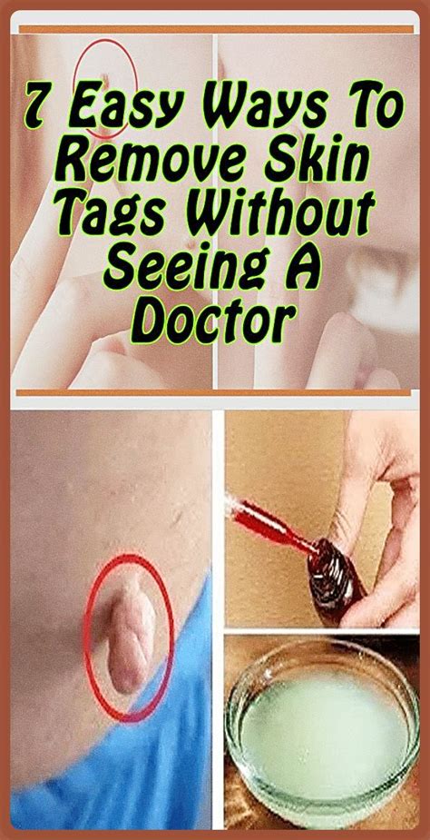 7 easy ways to remove skin tags without visiting a doctor skin tag removal skin tag tee tree