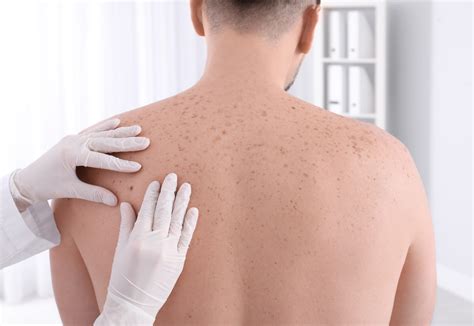 5 Skin Cancer Risk Factors To Consider Germain Dermatology