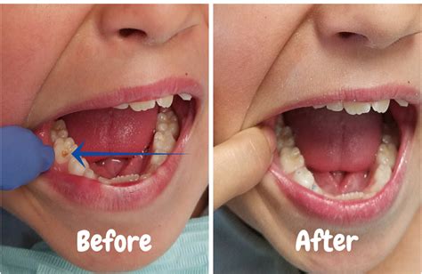 Dental Fillings Cavity Treatment — Shanna Chirco Dds