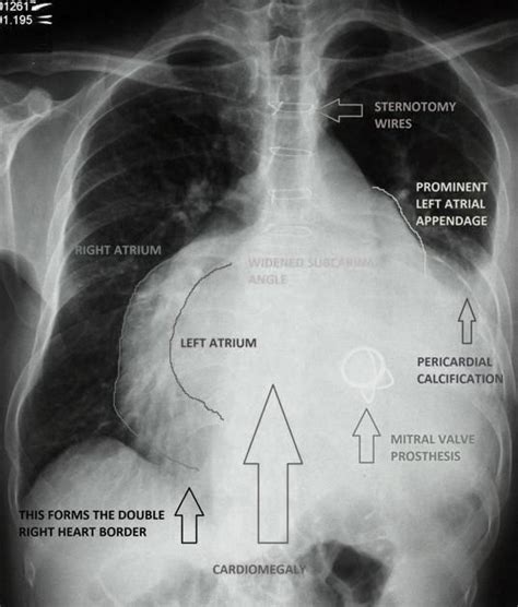Mitral Stenosis Radiology Reference Article