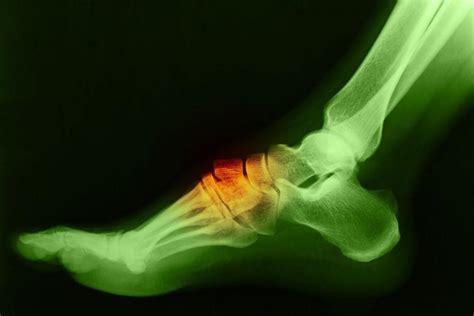 Bony Bumps On The Top Of Your Feet Could Be Bone Spurs Next Step Foot