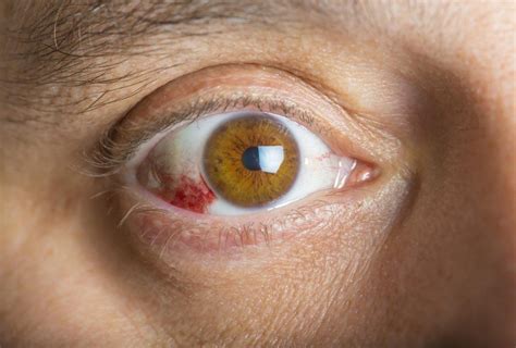 What Is A Subconjunctival Hemorrhage Premier Eye Associates