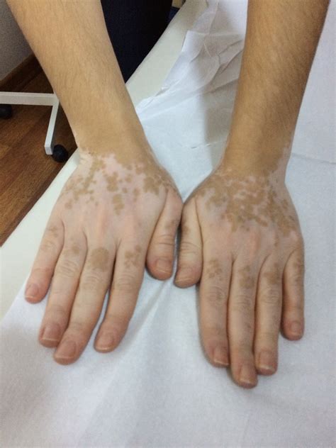 Die erkrankung verläuft in schüben und meist chronisch. Vitiligo nasıl geçer? Vitiligo nedir? | Beyazlama ...