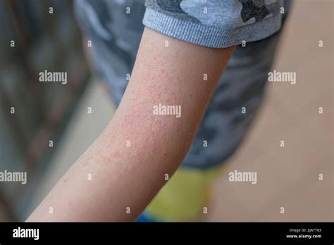 Little Child Arm With Atopic Dermatitis Rash Health Care Skin Allergy
