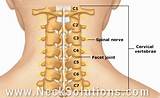 Cervical Pinched Nerve Treatment Pictures