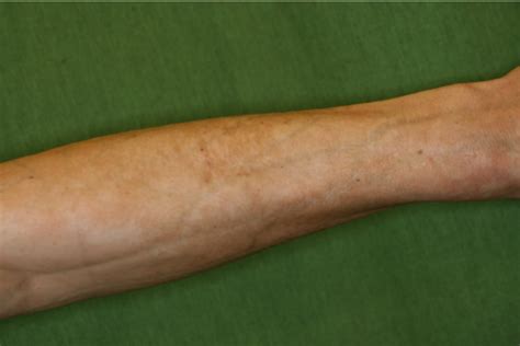 Classical Symptoms Of Eosinophilic Fasciitis With Venous Furrowing On