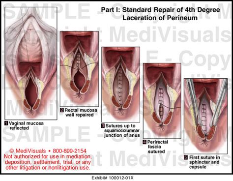 MediVisuals Standard Repair Of 4th Degree Laceration Of Perineum
