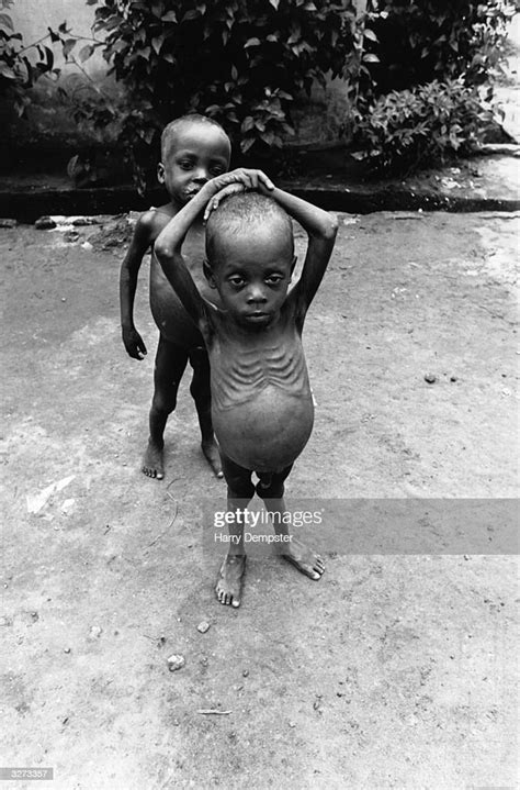 Starving Nigerian Children At The Nigar Hospital Port Harcourt