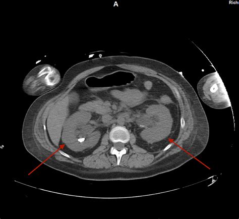 Cureus A Case Of Bilateral Infected Kidney Stones Presenting With