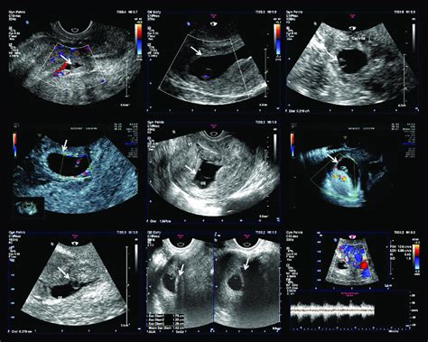Transvaginal Sonography Of Uterine Incision Pregnancy Transvaginal My
