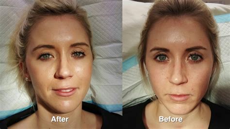 Before and after minimalism and what changed. Juvederm rejuvenation w/ Before & After Pictures - YouTube