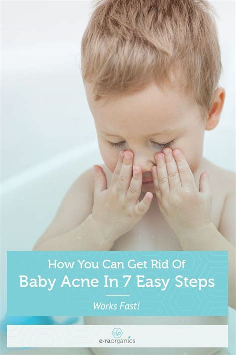 Natural Baby Acne Remedy In 7 Easy Steps Infant Skin Care Done Right