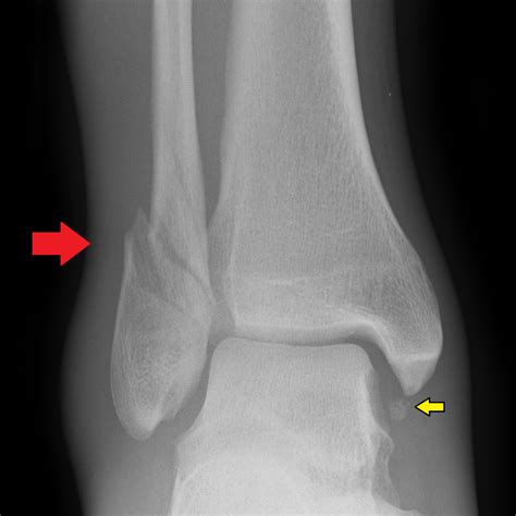 Fracture is the term given to a broken bone. Ankle Fractures (Tibia and Fibula) - Musculoskeletal ...