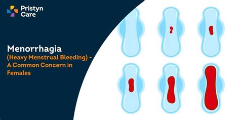 Menorrhagia Heavy Menstrual Bleeding A Common Concern In Females