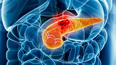 Early detection is key to pancreatic cancer survival. 21 Signs And Symptoms Of Pancreatic Cancer • Page 5 of 23
