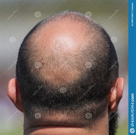 Bald Patch On The Head Of A Man Stock Image Image Of Closeup Male