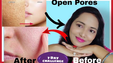 Open Pores Large Pores Clogged Pores Get Rid Of Open Pores Naturally