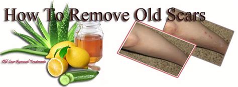 Remove Scars From Legs Herbal Acne Treatment Recipe