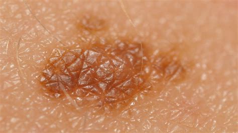 Skin Cancer Moles Idaman