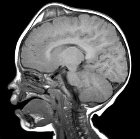 Subgaleal Hematoma In A Newborn Sagittal T1 Weighted Mr Image Shows A