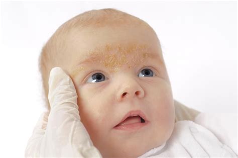Rash On A Babys Face Pictures Causes And Treatments Baby Acne