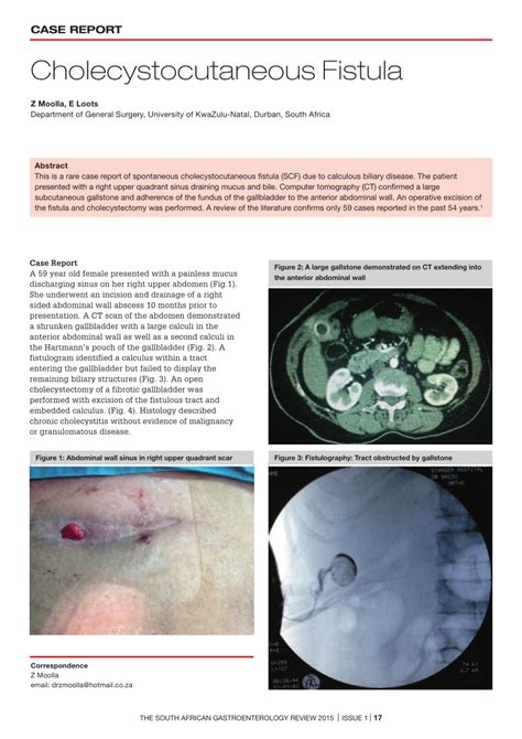 PDF Cholecystocutaneous Fistula