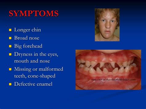 Ppt Ectodermal Dysplasia Dental Calamity In Your Mouth Powerpoint