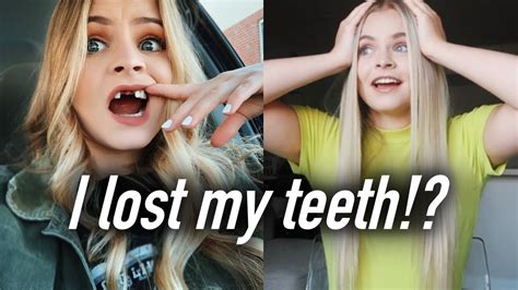 I Lost My Front Two Teeth Ft Real Surgery Footage Youtube