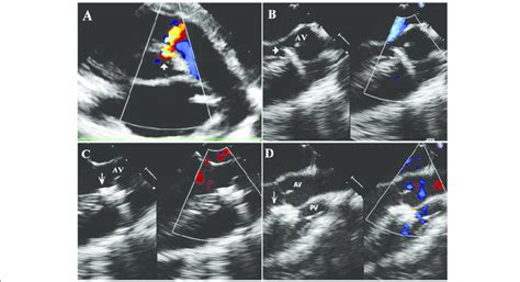 Different Steps Of Perventricular Device Closure Of A Small Doubly