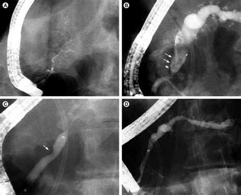 Endoscopic Removal Of Main Pancreatic Duct Stones Via The Minor