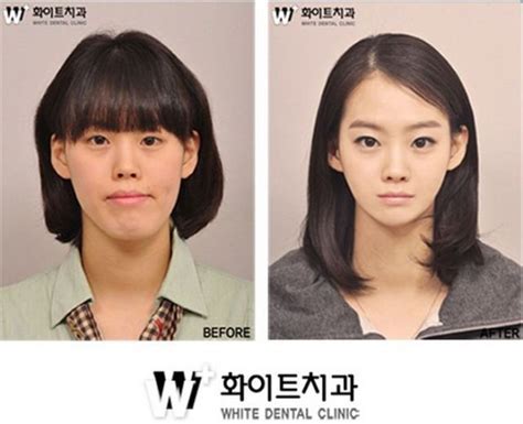 Before And After Photos Of Korean Plastic Surgery PICS Izismile Com